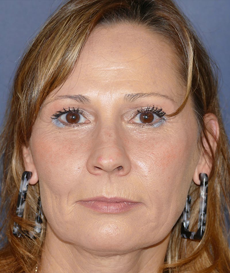 Rhinoplasty Before & After Gallery - Patient 266289 - Image 1