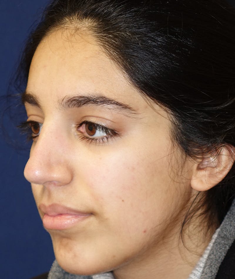 Rhinoplasty Before & After Gallery - Patient 277048 - Image 10