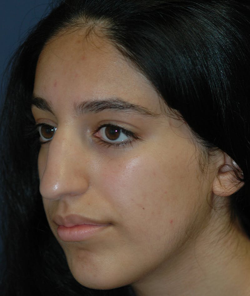 Rhinoplasty Before & After Gallery - Patient 277048 - Image 9