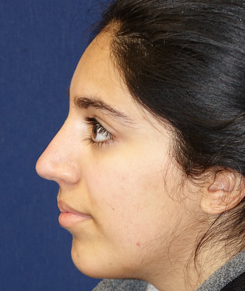 Rhinoplasty Before & After Gallery - Patient 277048 - Image 8
