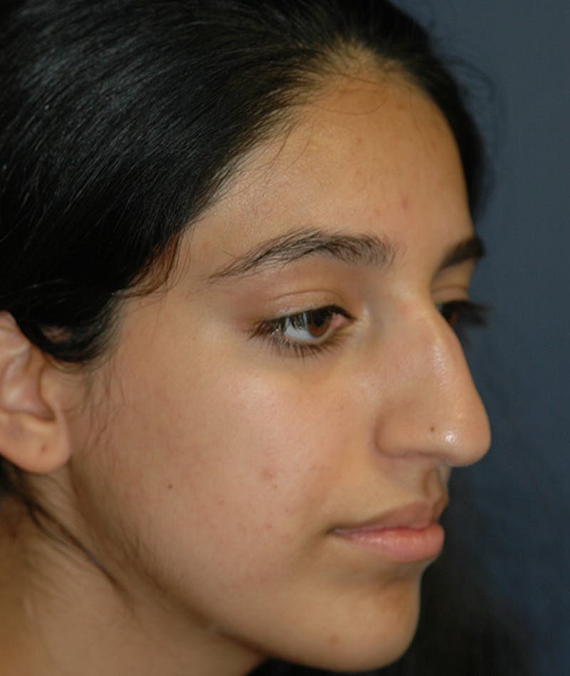 Rhinoplasty Before & After Gallery - Patient 277048 - Image 5