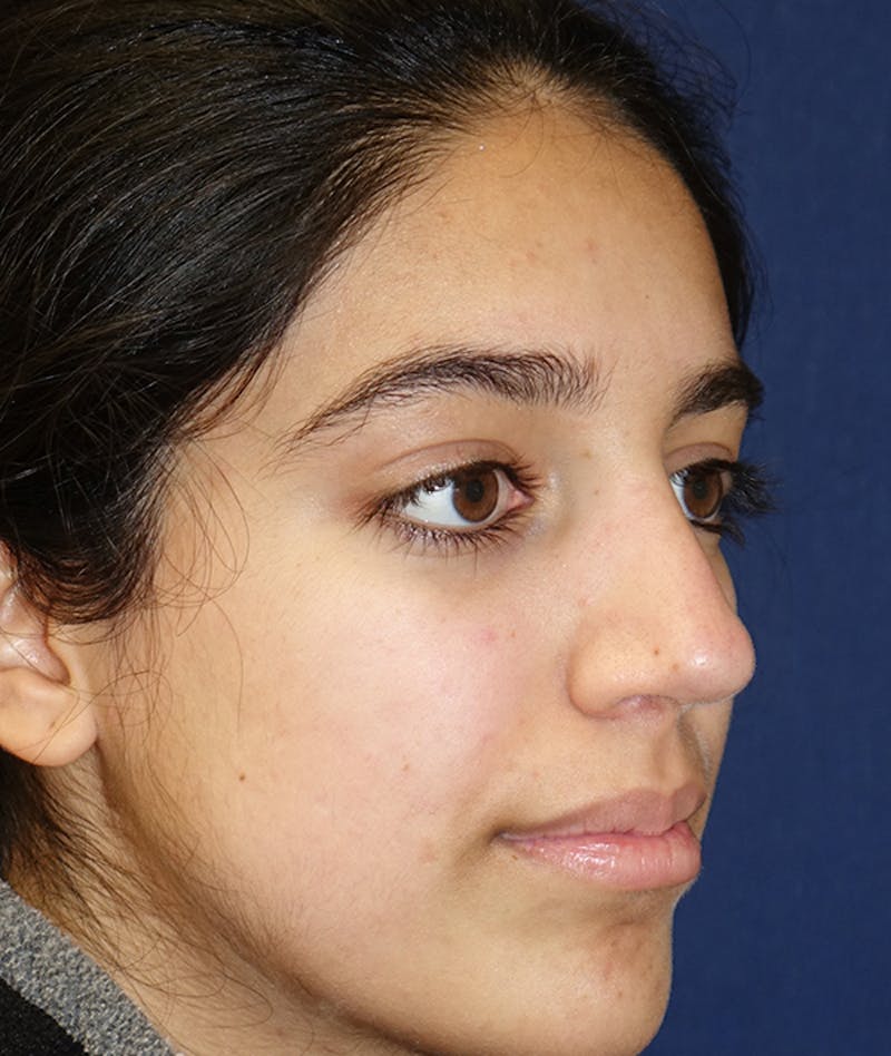 Rhinoplasty Before & After Gallery - Patient 277048 - Image 6