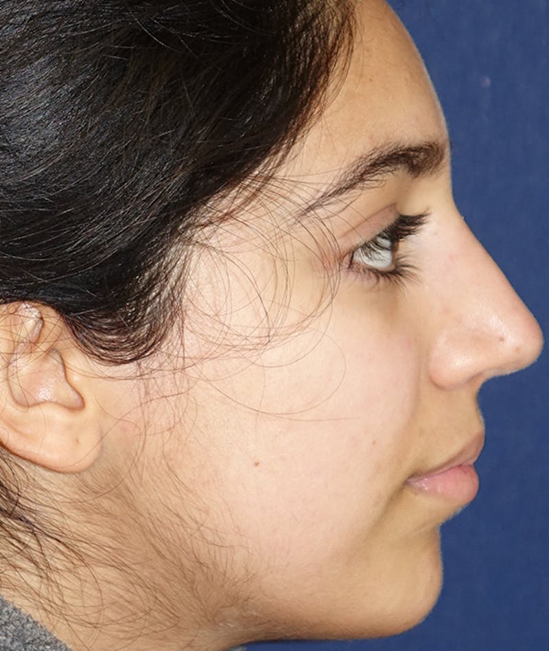 Rhinoplasty Before & After Gallery - Patient 277048 - Image 4