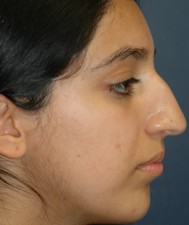 Rhinoplasty Before & After Gallery - Patient 277048 - Image 3