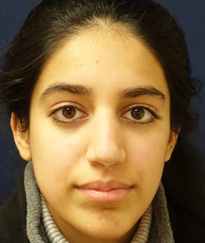 Rhinoplasty Before & After Gallery - Patient 277048 - Image 2