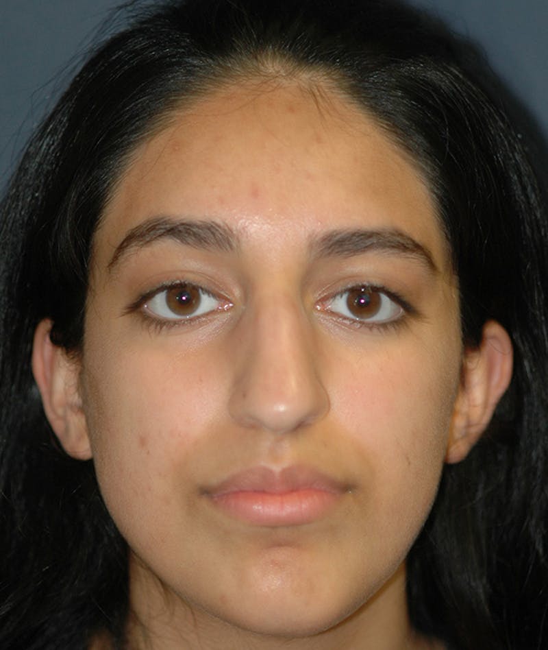 Rhinoplasty Before & After Gallery - Patient 277048 - Image 1
