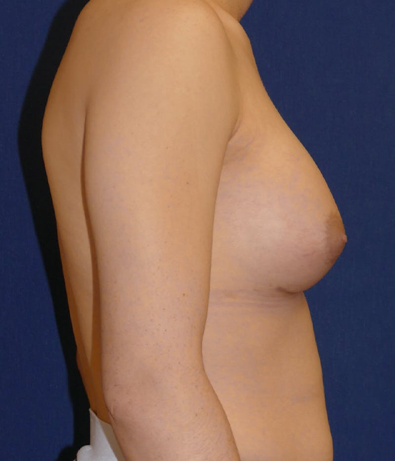 Feminizing Surgery Before & After Gallery - Patient 315458 - Image 8