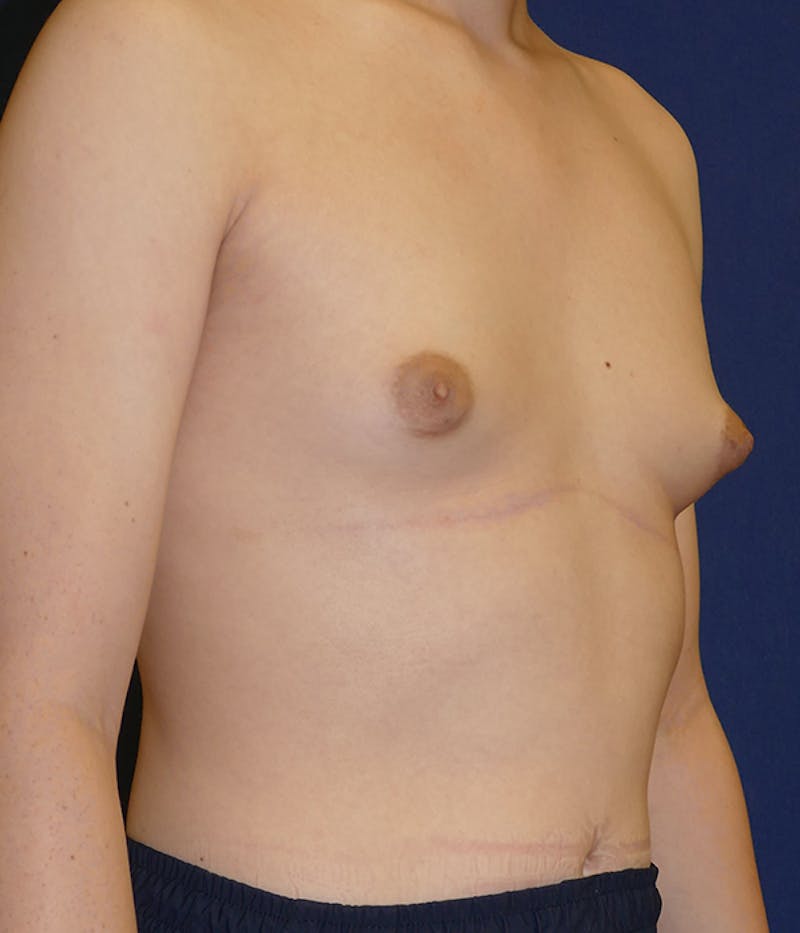 Feminizing Surgery Before & After Gallery - Patient 315458 - Image 9