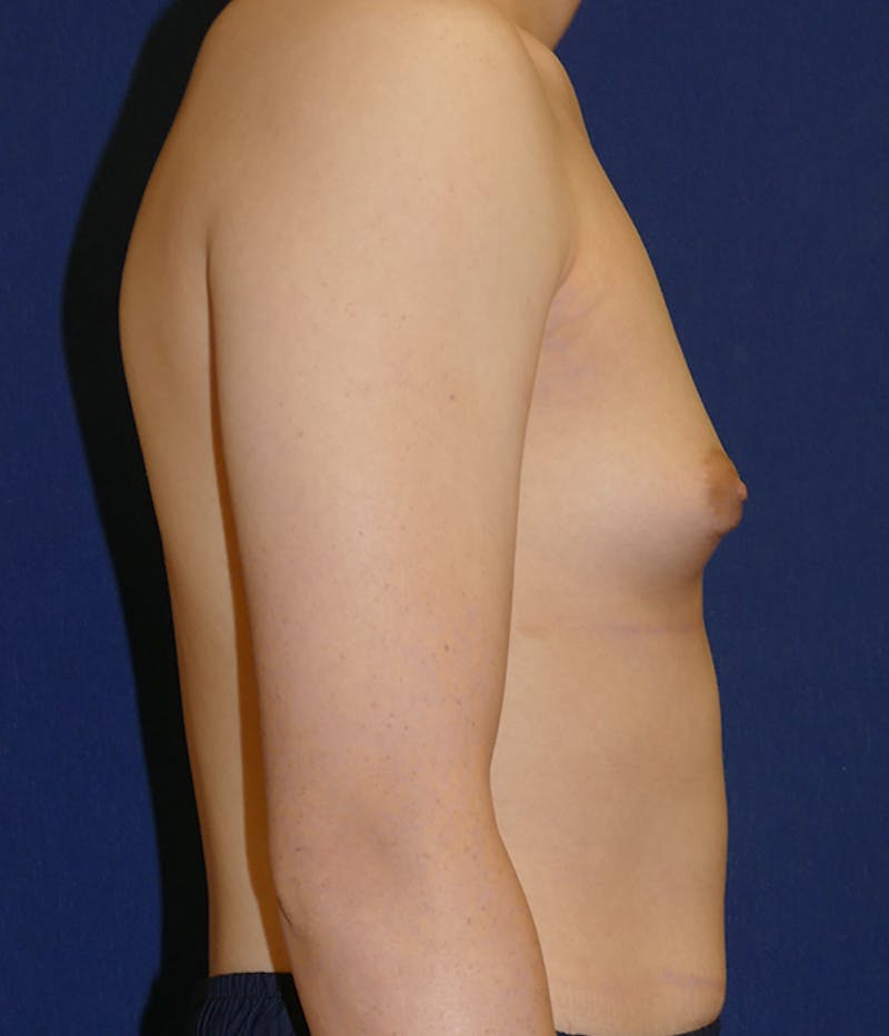 Feminizing Surgery Before & After Gallery - Patient 315458 - Image 7