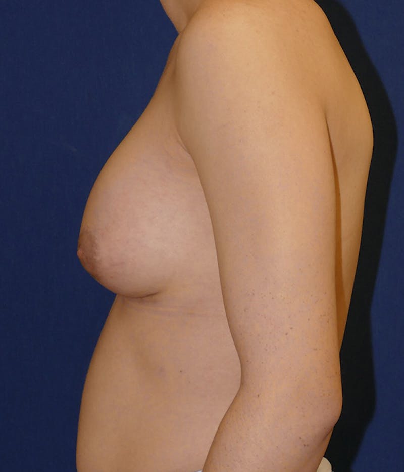 Feminizing Surgery Before & After Gallery - Patient 315458 - Image 4