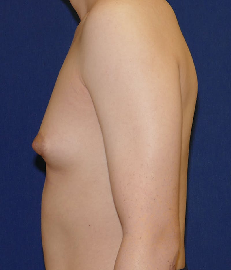 Feminizing Surgery Before & After Gallery - Patient 315458 - Image 3
