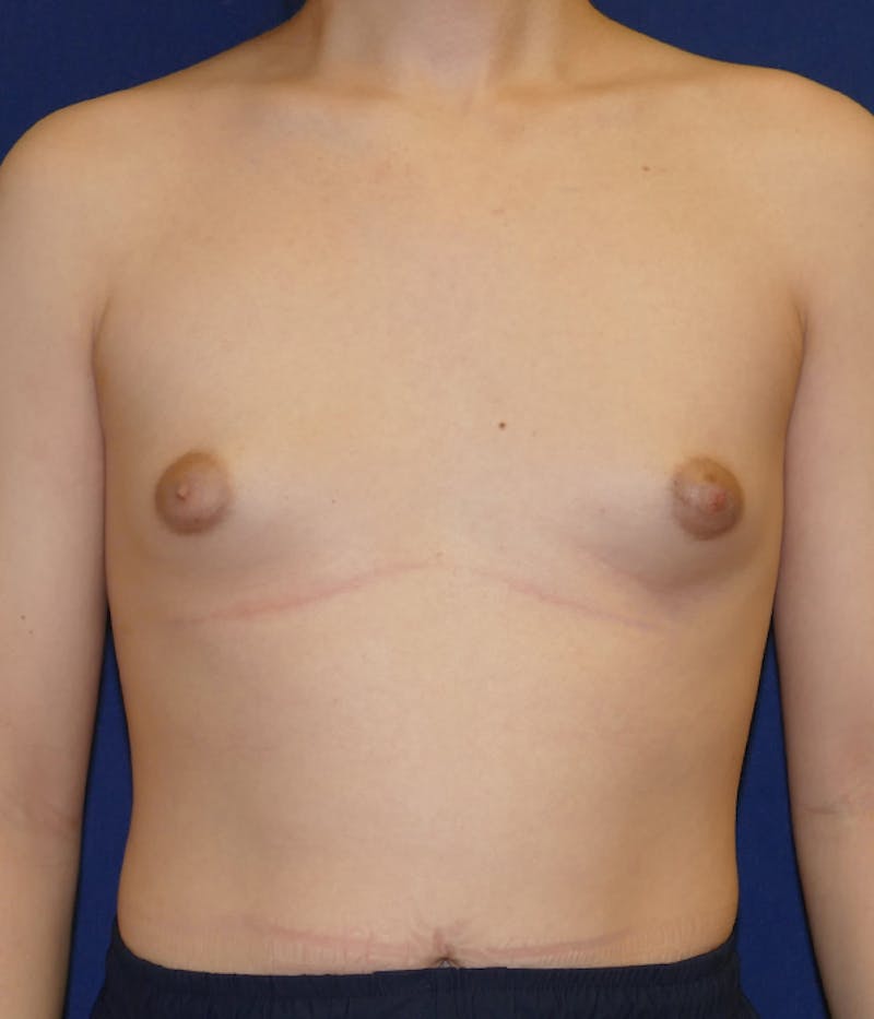 Feminizing Surgery Before & After Gallery - Patient 315458 - Image 1