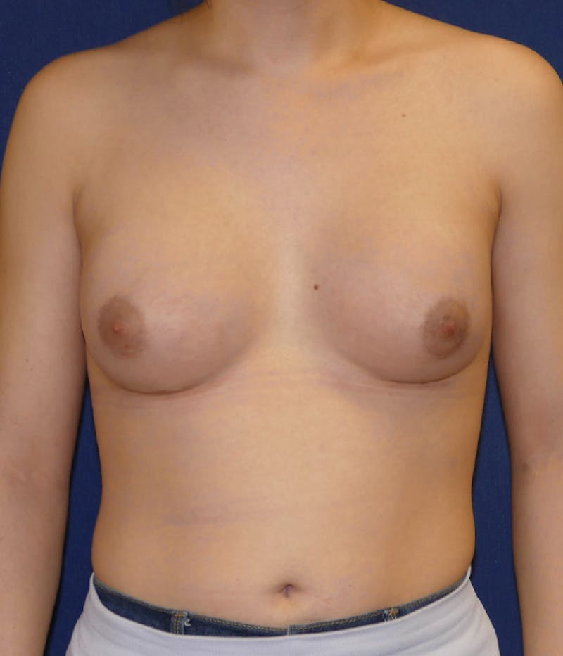 Feminizing Surgery Before & After Gallery - Patient 315458 - Image 2