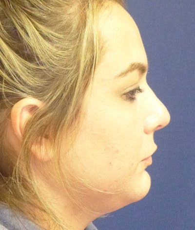 Chin Augmentation Before & After Gallery - Patient 100449 - Image 2