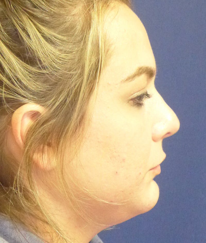 Chin Augmentation Before & After Gallery - Patient 100449 - Image 2