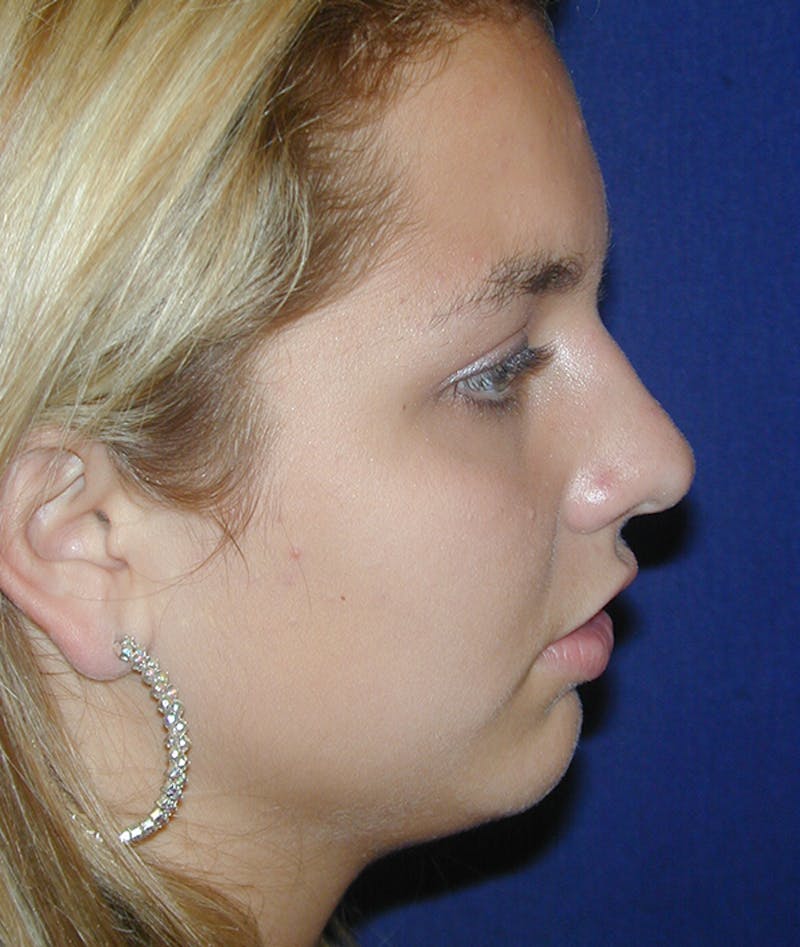 Chin Augmentation Before & After Gallery - Patient 100449 - Image 1