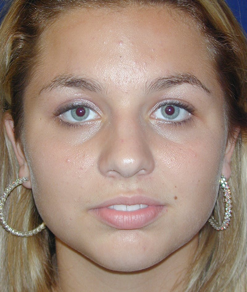 Chin Augmentation Before & After Gallery - Patient 100449 - Image 3