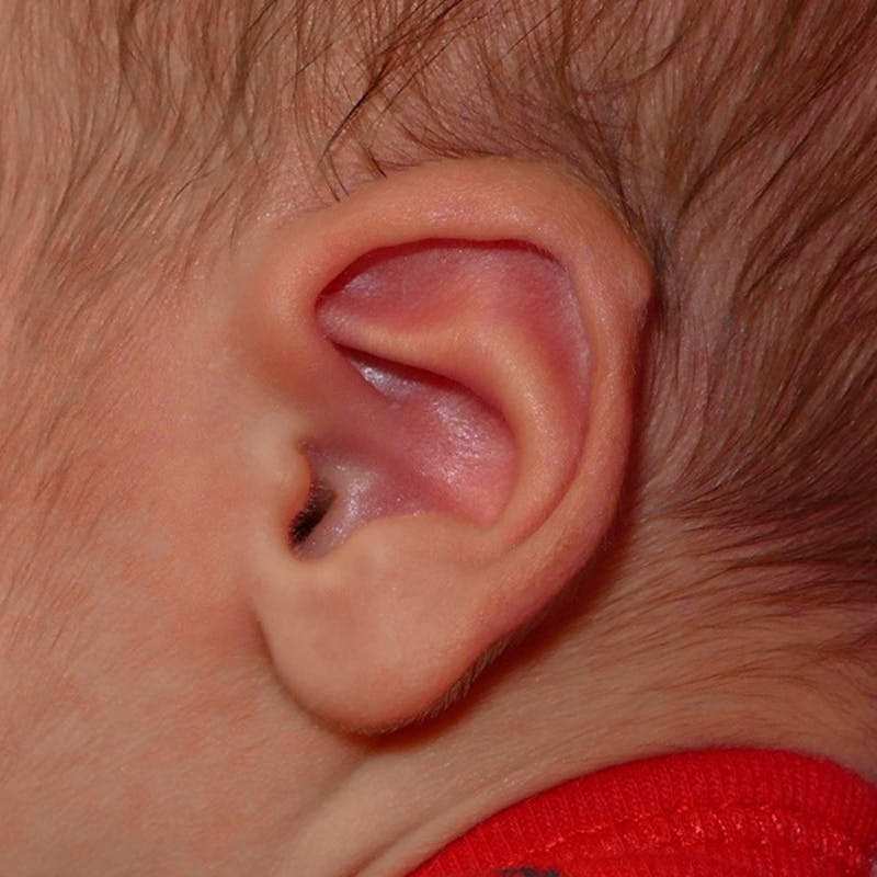 Pediatric Ear Molding Before & After Gallery - Patient 254045 - Image 3