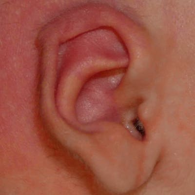 Pediatric Ear Molding Before & After Gallery - Patient 254045 - Image 2