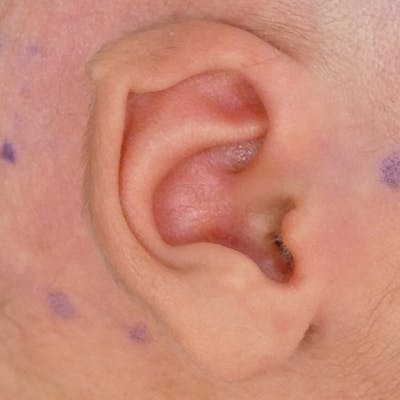 Pediatric Ear Molding Before & After Gallery - Patient 254045 - Image 1
