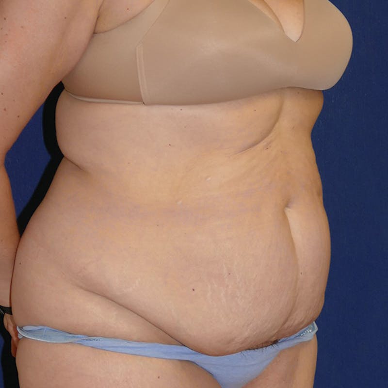 Tummy Tuck (Abdominoplasty) Before & After Gallery - Patient 423471 - Image 5