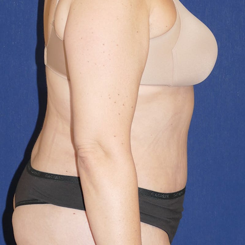 Tummy Tuck (Abdominoplasty) Before & After Gallery - Patient 423471 - Image 4