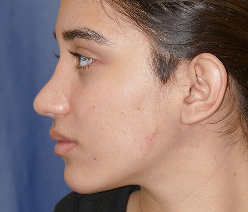 Miscellaneous Before & After Gallery - Patient 161826 - Image 4