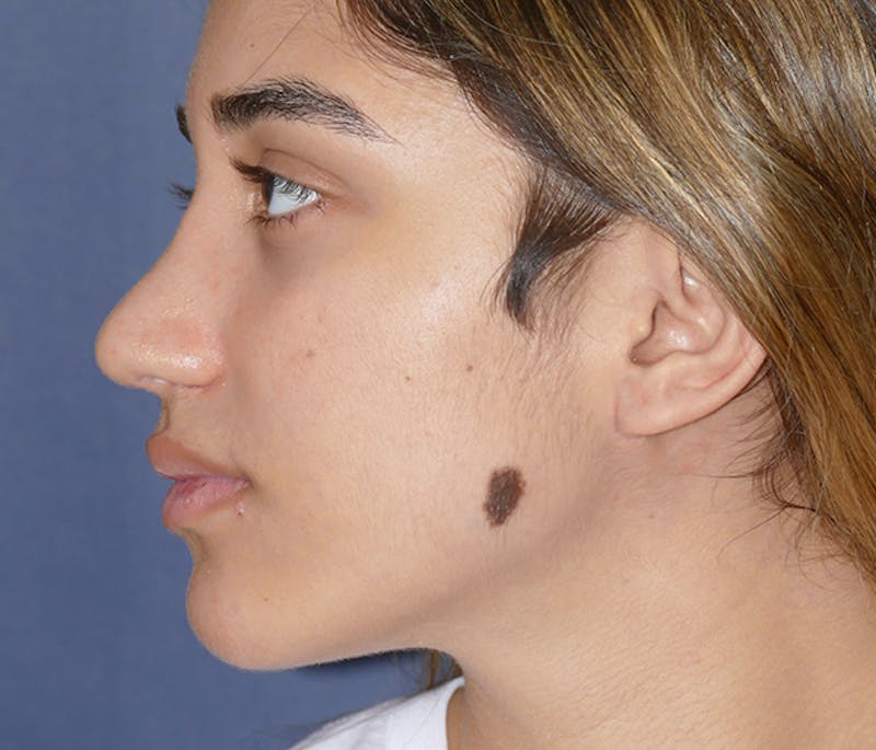 Miscellaneous Before & After Gallery - Patient 161826 - Image 3