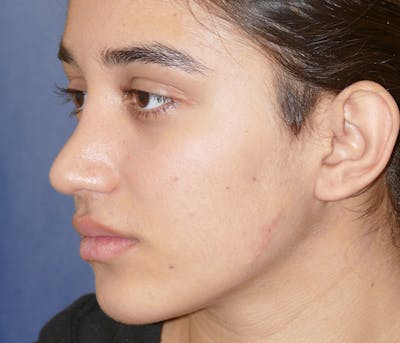 Miscellaneous Before & After Gallery - Patient 161826 - Image 2