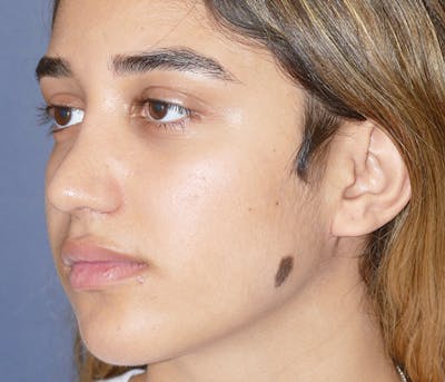 Miscellaneous Before & After Gallery - Patient 161826 - Image 1