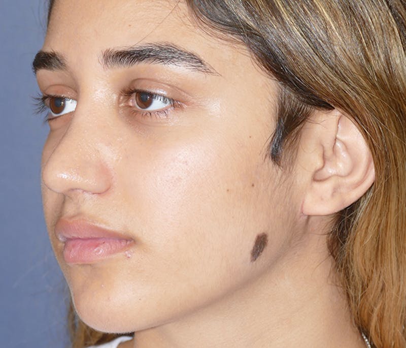 Miscellaneous Before & After Gallery - Patient 161826 - Image 1