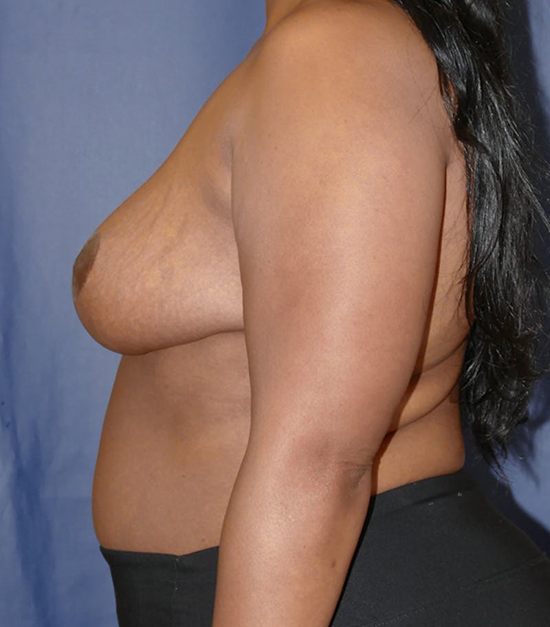 Breast Reduction Before & After Gallery - Patient 216088 - Image 10