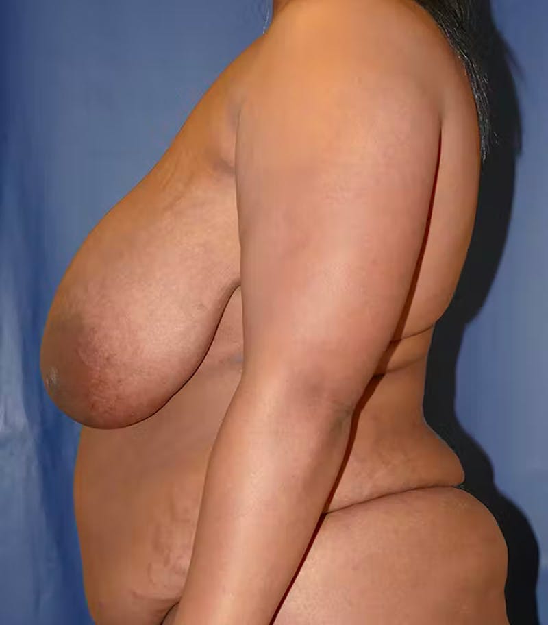 Breast Reduction Before & After Gallery - Patient 216088 - Image 9