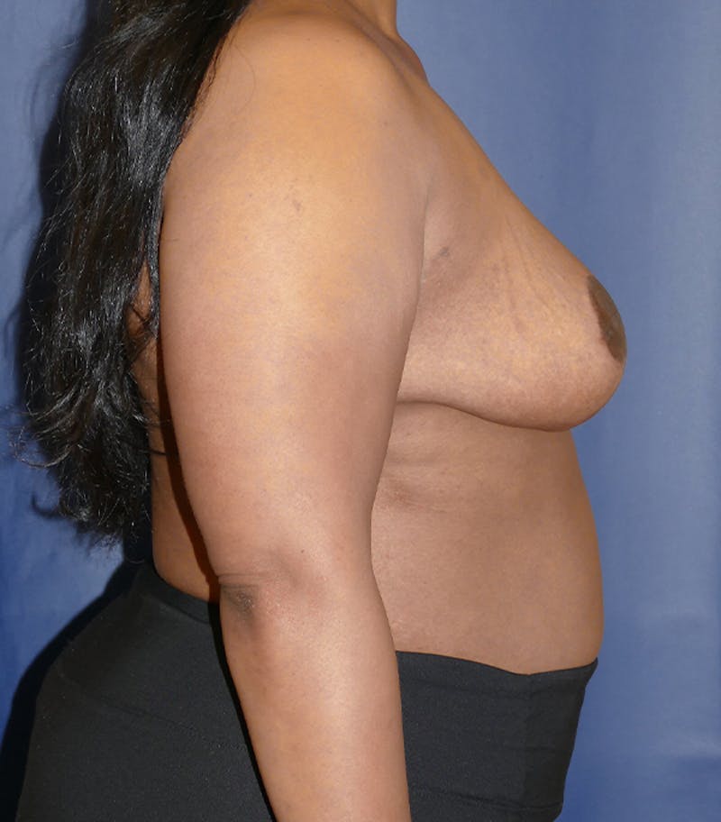 Breast Reduction Before & After Gallery - Patient 216088 - Image 6