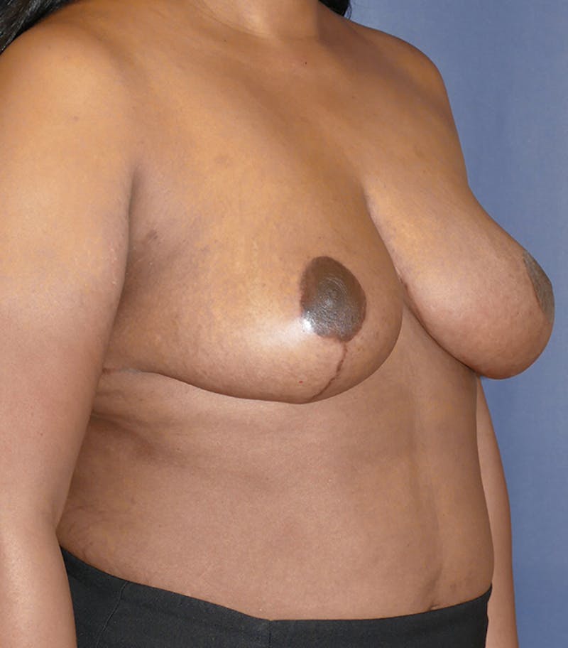 Breast Reduction Before & After Gallery - Patient 216088 - Image 4