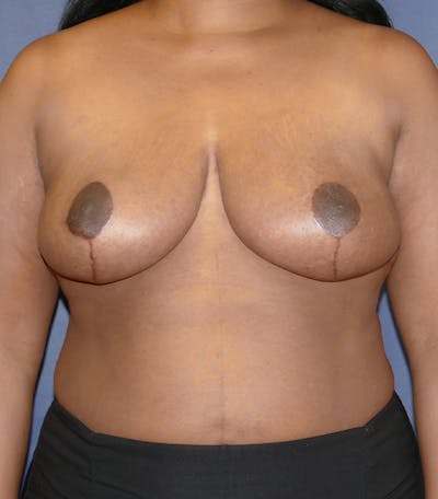 Breast Reduction Before & After Gallery - Patient 216088 - Image 2