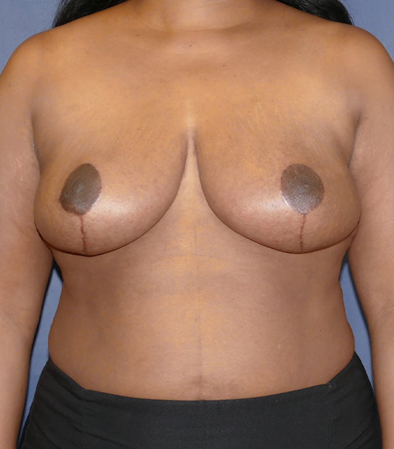 Breast Reduction Before & After Gallery - Patient 216088 - Image 2
