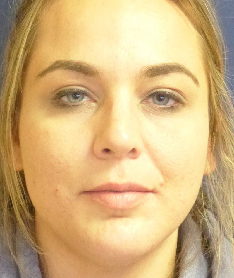 Rhinoplasty Before & After Gallery - Patient 285531 - Image 4