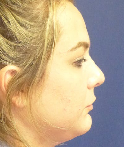 Rhinoplasty Before & After Gallery - Patient 285531 - Image 2