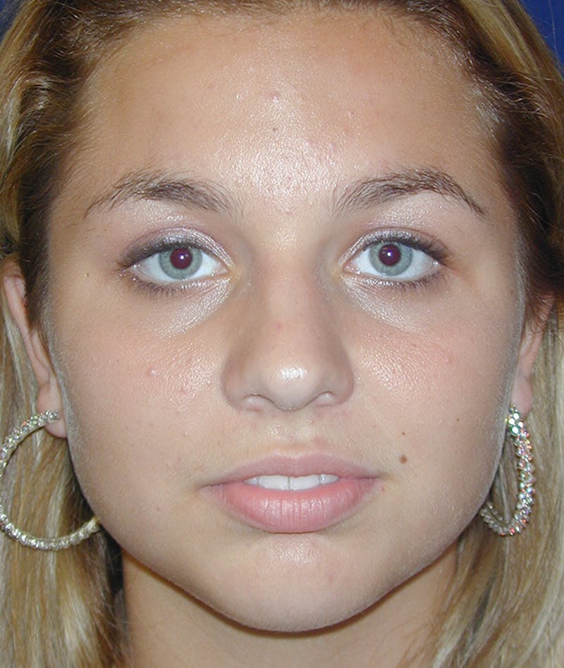 Rhinoplasty Before & After Gallery - Patient 285531 - Image 3