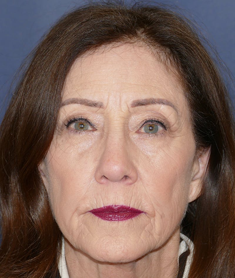 Rhinoplasty Before & After Gallery - Patient 336631 - Image 6