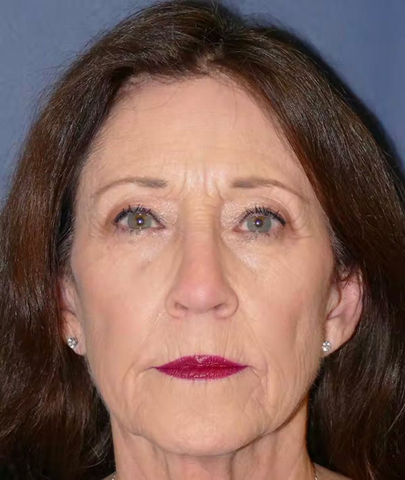 Rhinoplasty Before & After Gallery - Patient 336631 - Image 5