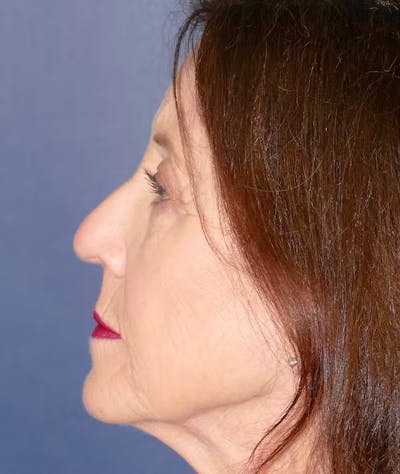 Rhinoplasty Before & After Gallery - Patient 336631 - Image 1