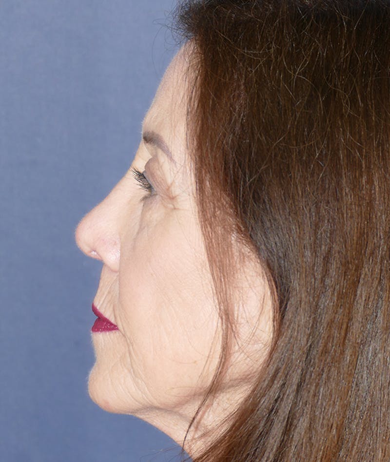Rhinoplasty Before & After Gallery - Patient 336631 - Image 2