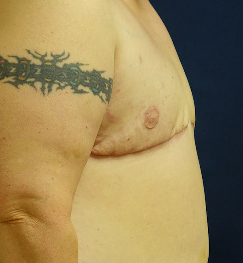 Masculinizing Surgery Before & After Gallery - Patient 316932 - Image 4