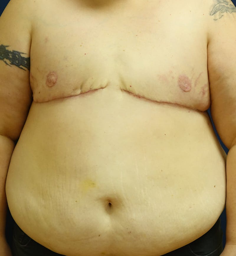 Masculinizing Surgery Before & After Gallery - Patient 316932 - Image 2