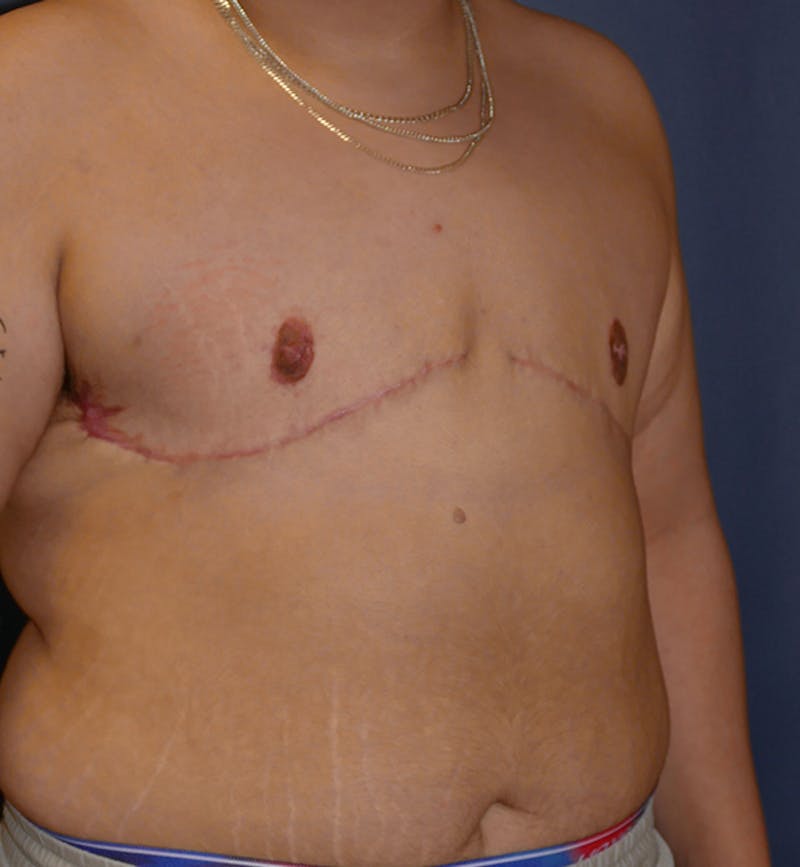 Masculinizing Surgery Before & After Gallery - Patient 395591 - Image 10