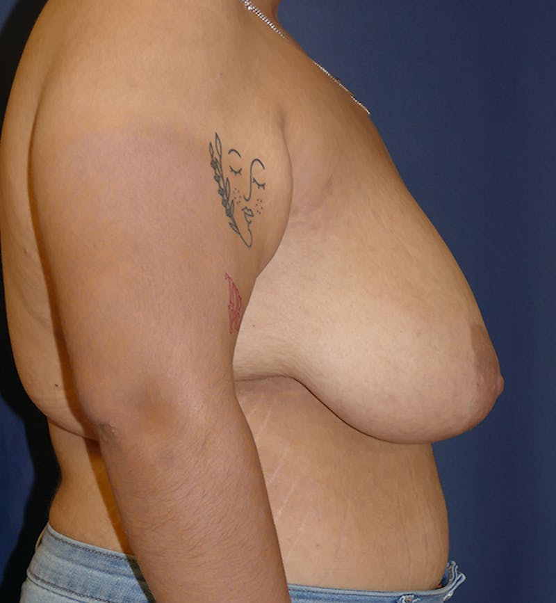 Masculinizing Surgery Before & After Gallery - Patient 395591 - Image 7