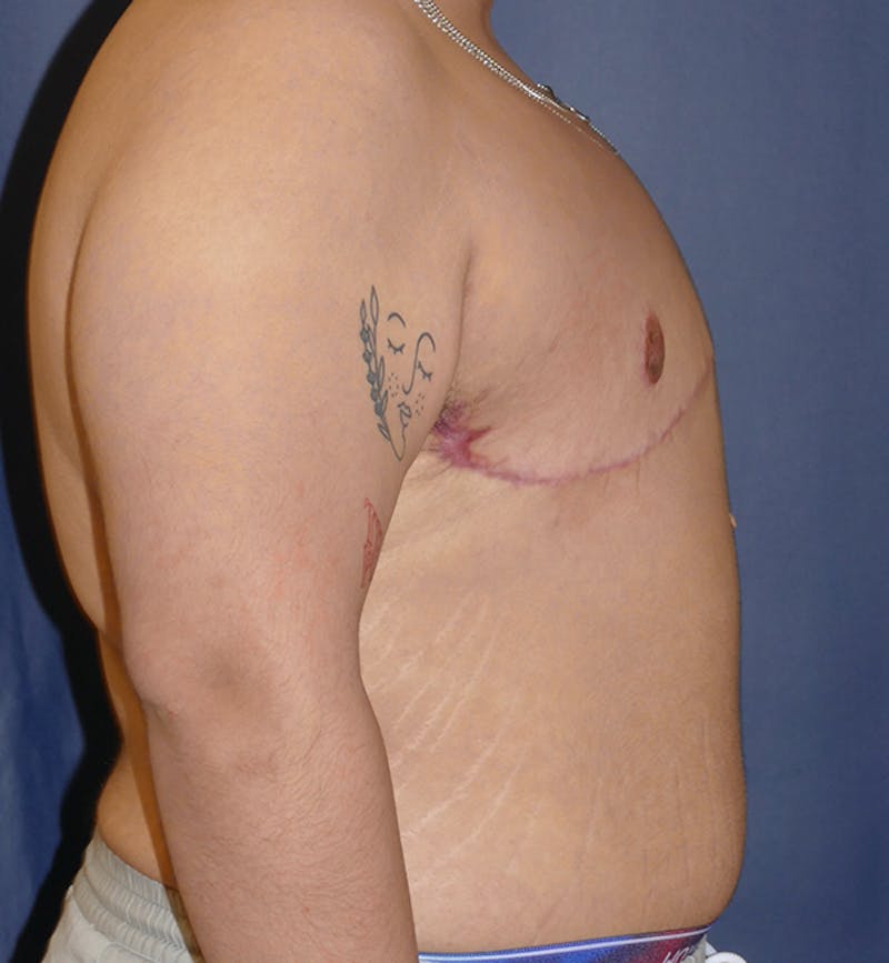Masculinizing Surgery Before & After Gallery - Patient 395591 - Image 8