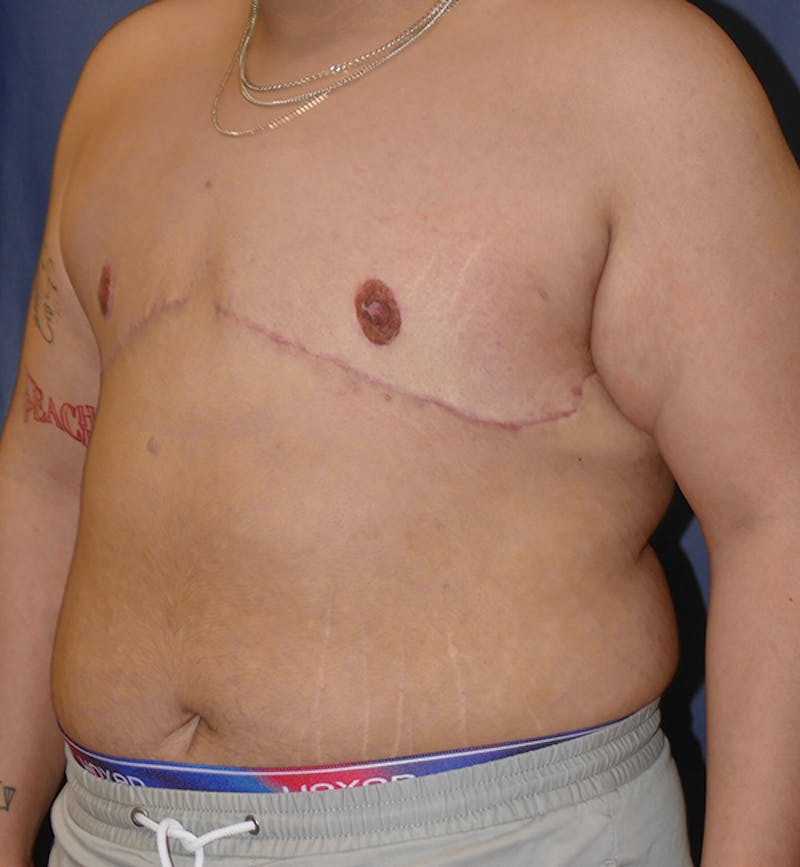 Masculinizing Surgery Before & After Gallery - Patient 395591 - Image 6